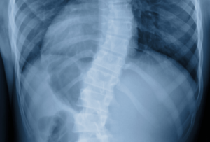 is scoliosis hereditary