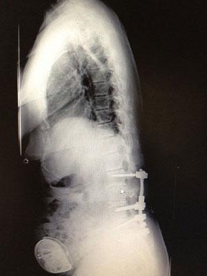 spine x-ray