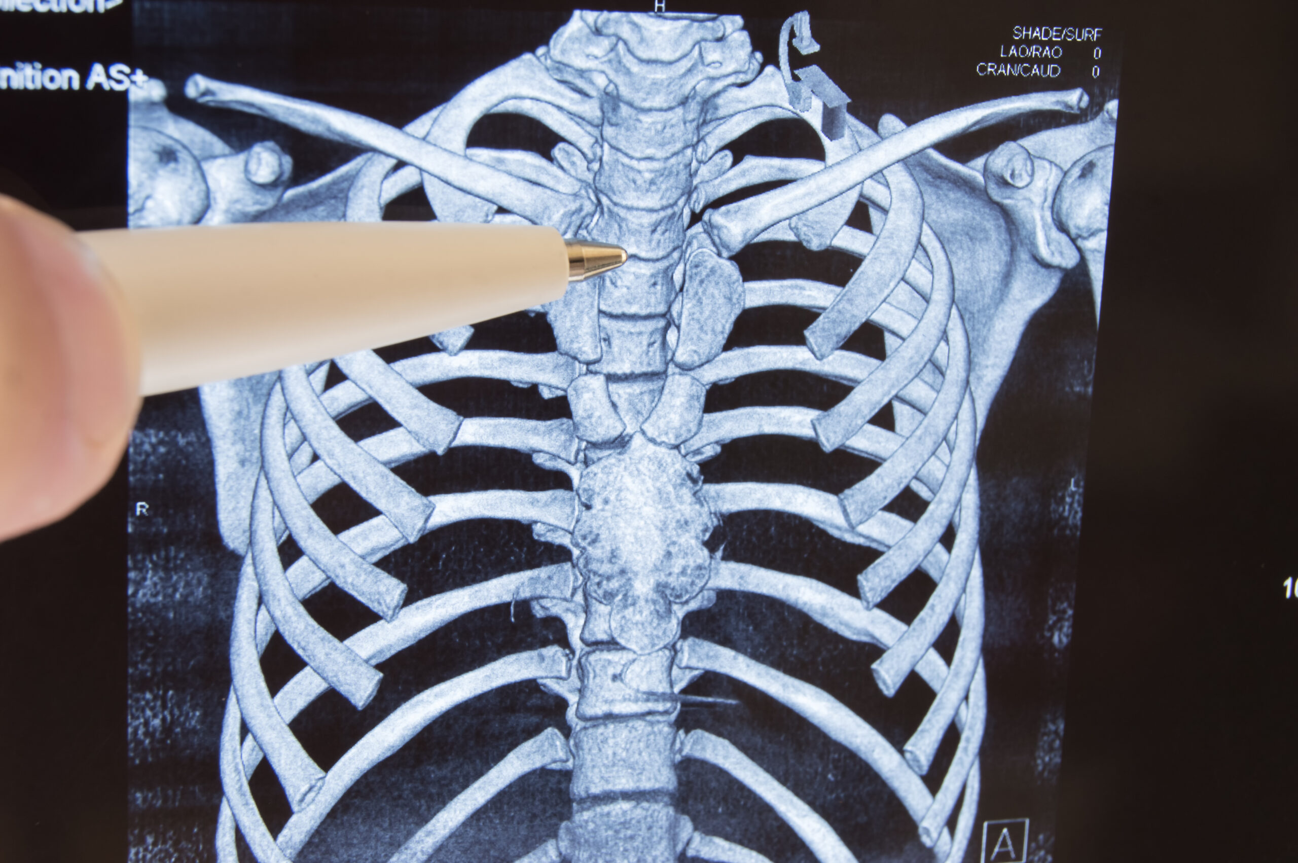 Minimally-invasive Spine Surgery In Beverly Hills, Ca